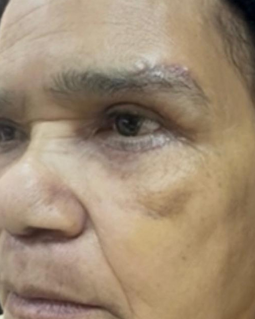 Resultado na região dos olhos, antes e depois (antes)