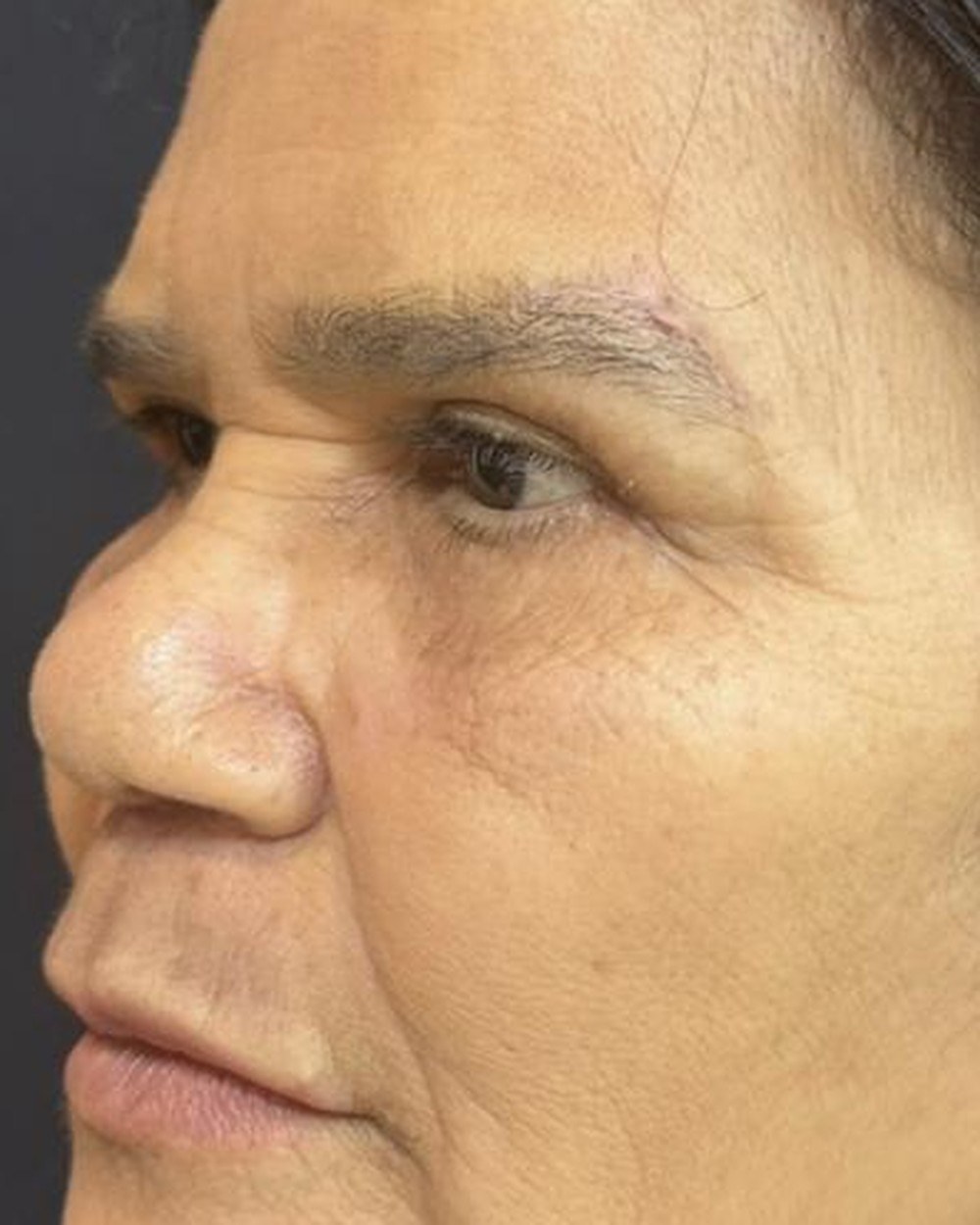 Resultado na região dos olhos, antes e depois (depois)