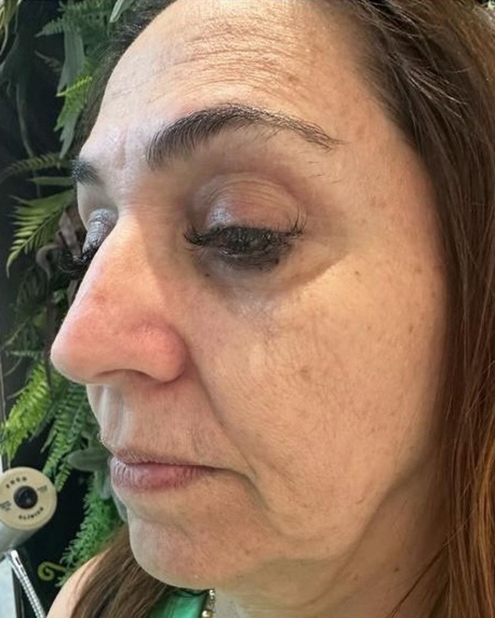 Resultado na região dos olhos, antes e depois (antes)