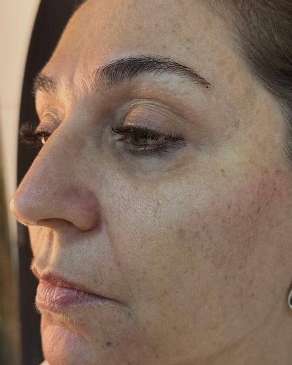 Resultado na região dos olhos, antes e depois (depois)